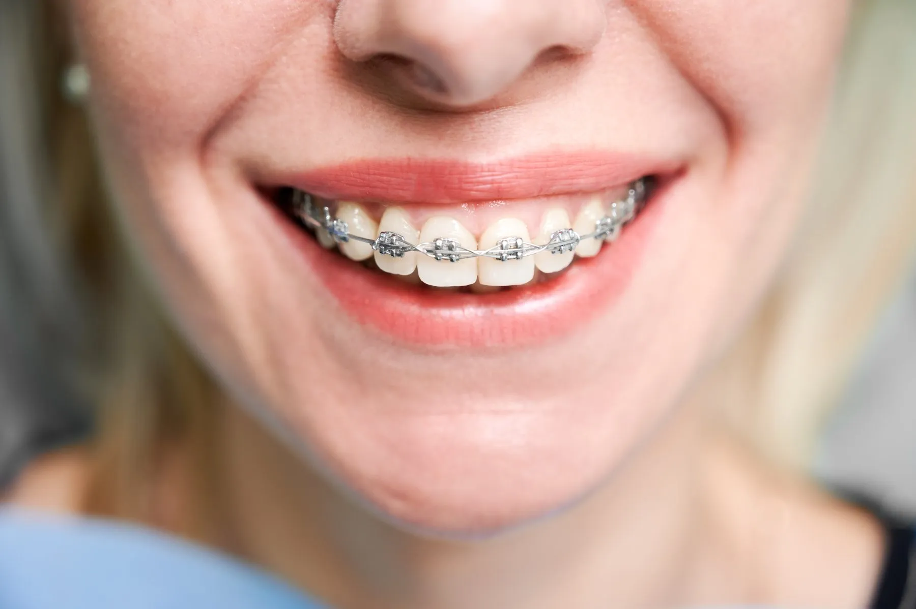 Sonrisa de mujer adulta con brackets estéticos