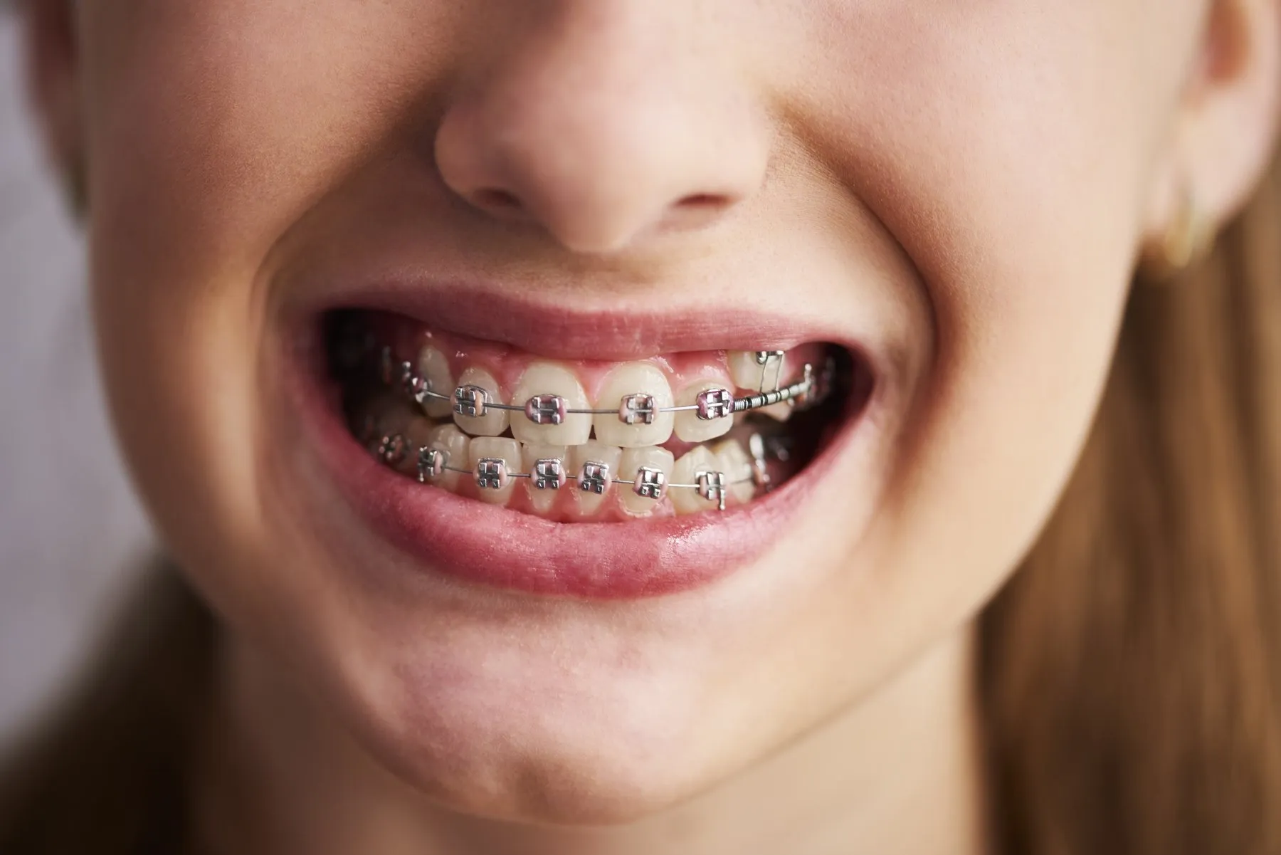 Sonrisa con brackets metálicos bien cuidados
